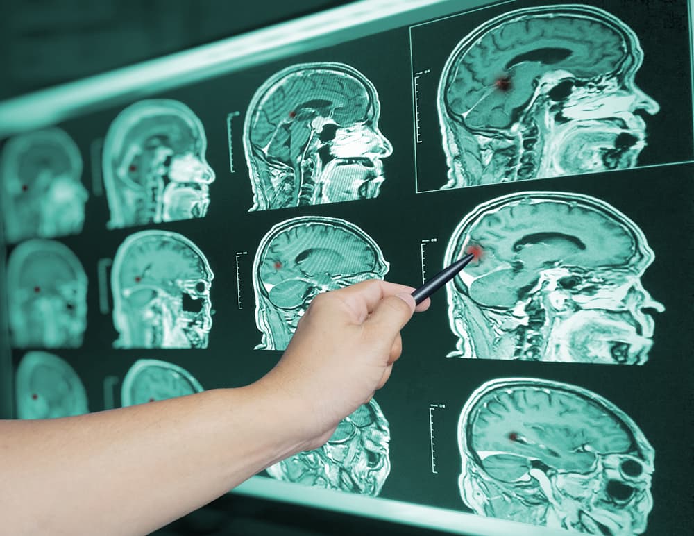 A hand pointing with a pen at brain scan images on a screen, highlighting injury spots.